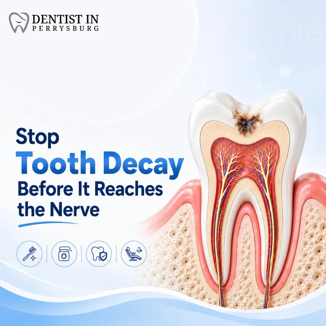 Stop Tooth Decay Before It Reaches the Nerve