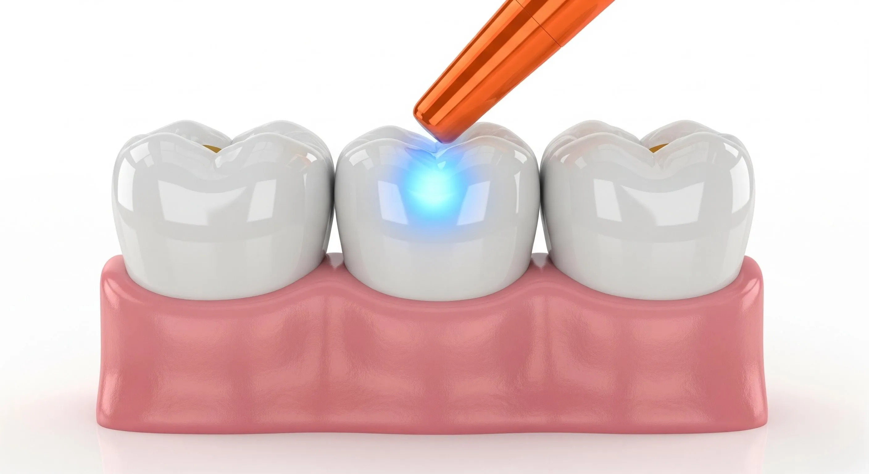 Composite Fillings Cost and Pricing Information in Perrysburg